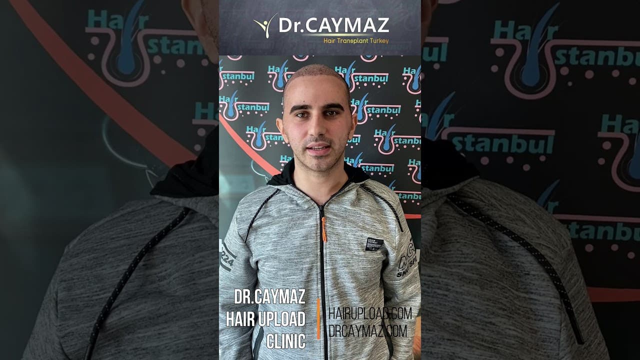 Mr VENHART from Serbia - 5500 Graft | | Hair Transplant Review 2021