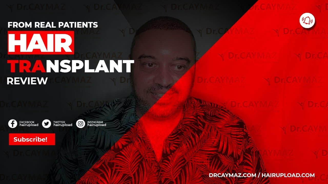 Mr.Florin - 5100 graft from United Kingdom | Hair Transplant | Dr.Erkam CAYMAZ