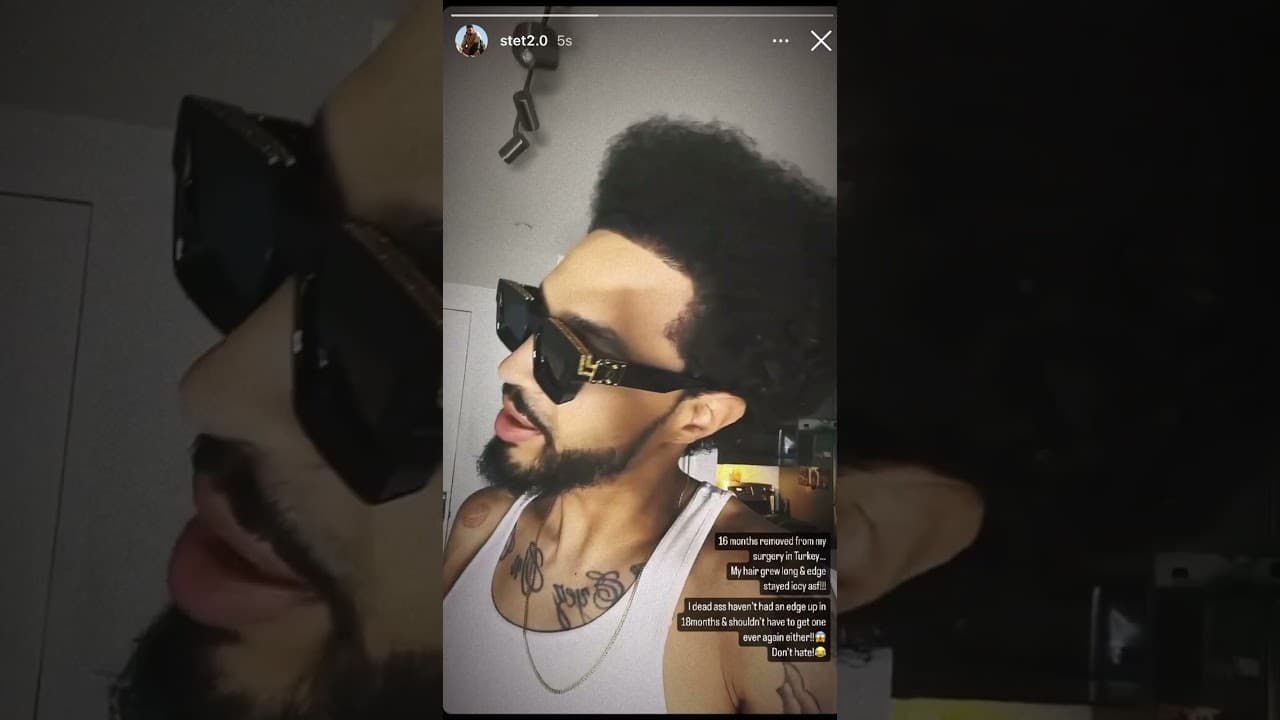 Hair Transplant Result