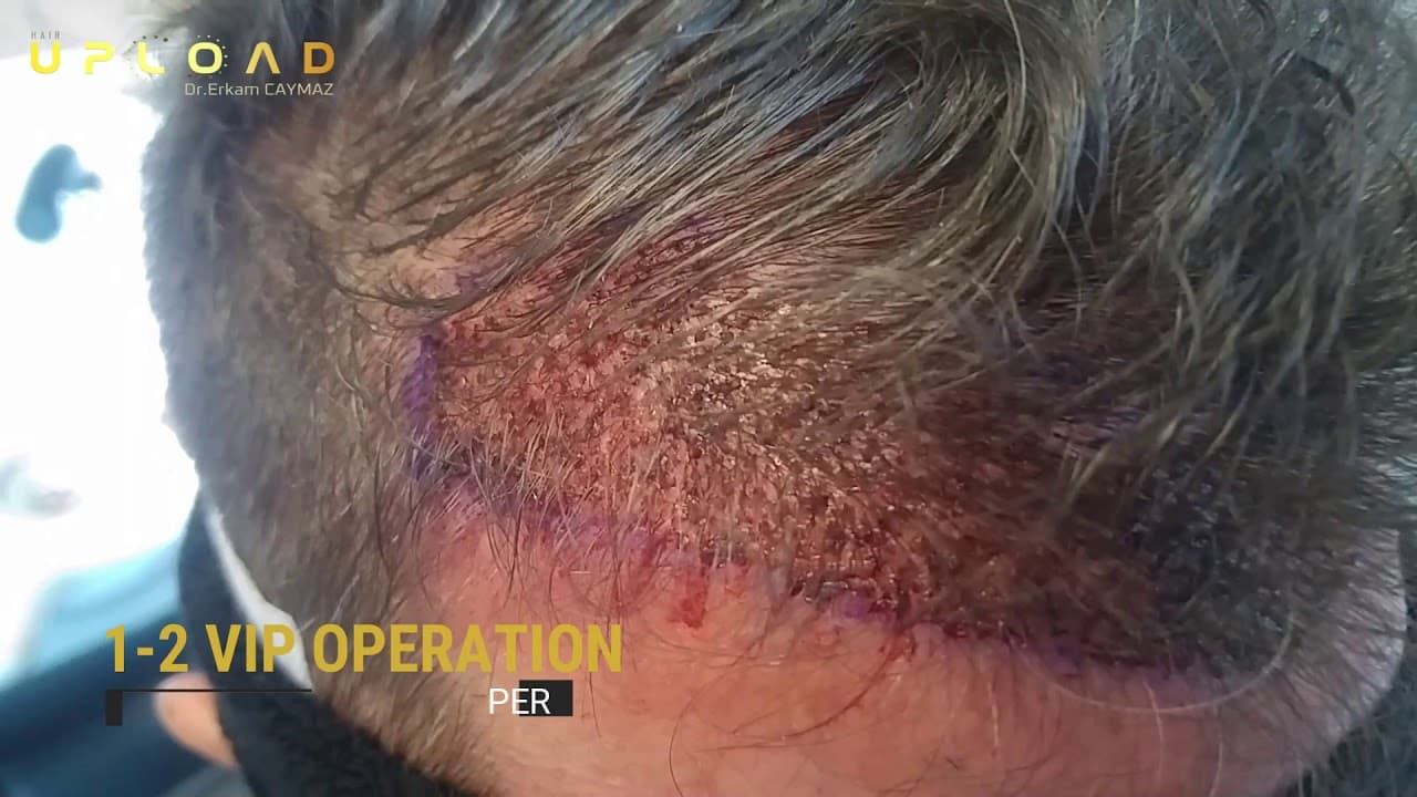 Unshaven Hair Transplantation