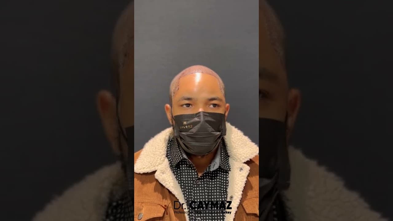 Mr Leonardo USA 4000 Graft Afro American Hair Transplant