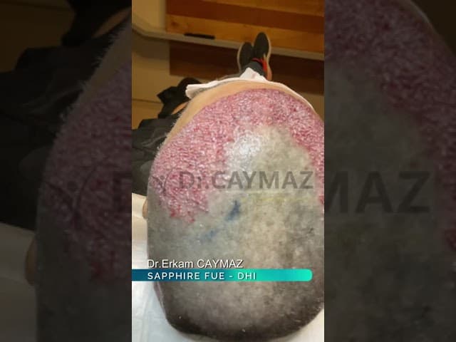 3700 Graft High Density in Turkey