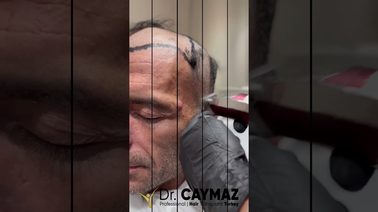 Vip Hair Transplantation by Doctor