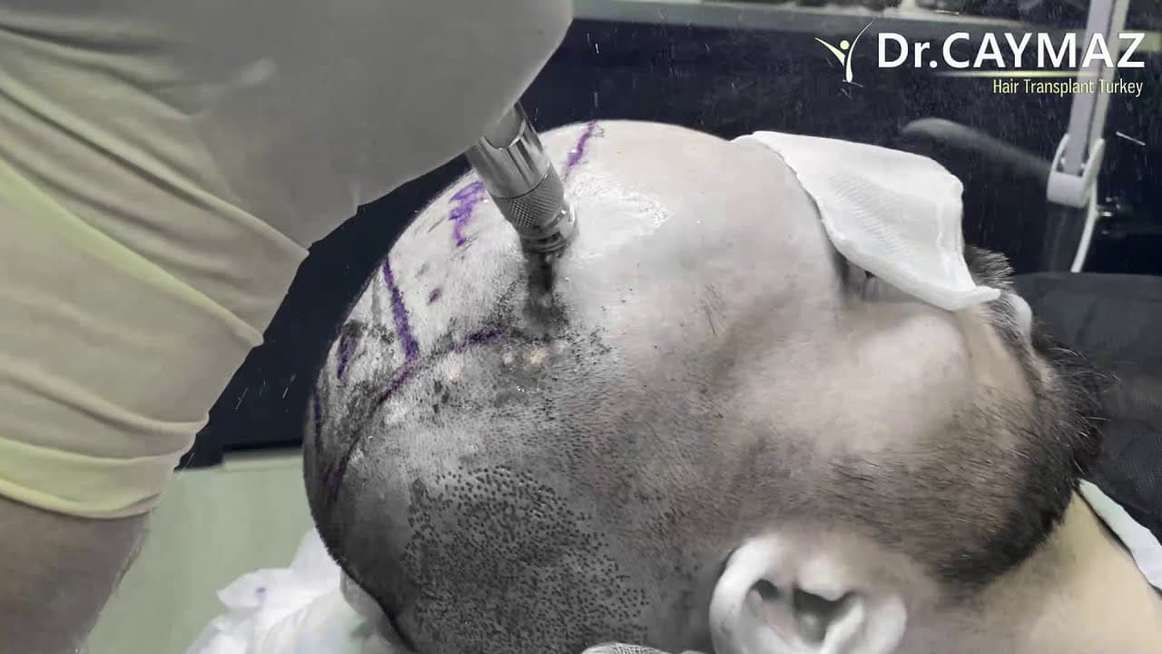 Painless Anesthesia Device - Hair Upload Clinic