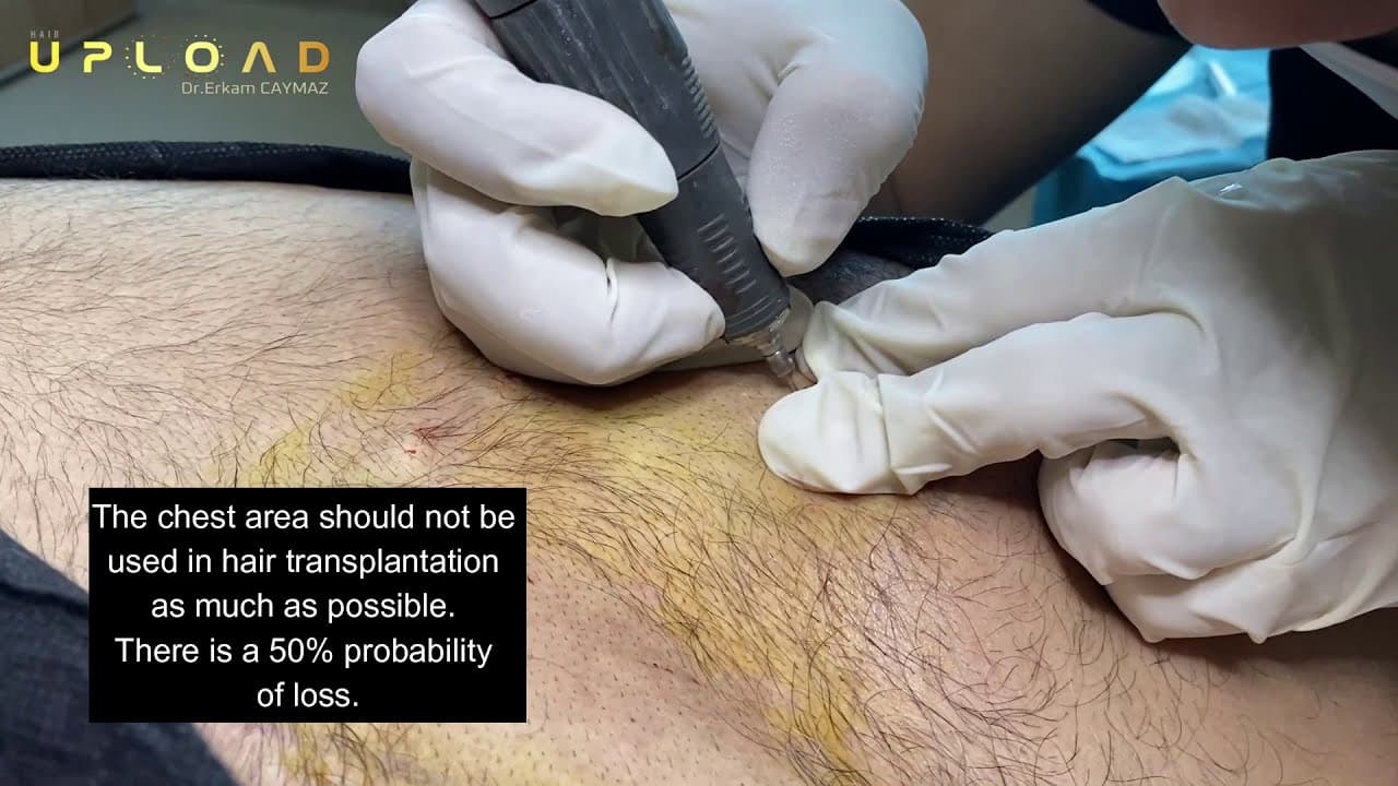 Chest Donor Area Body Hair Transplant