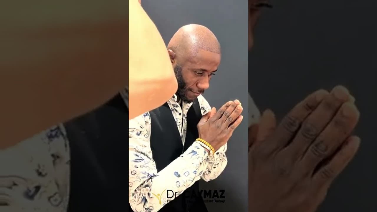 Mr Christopher - Australia - 3200 Graft by Doctor