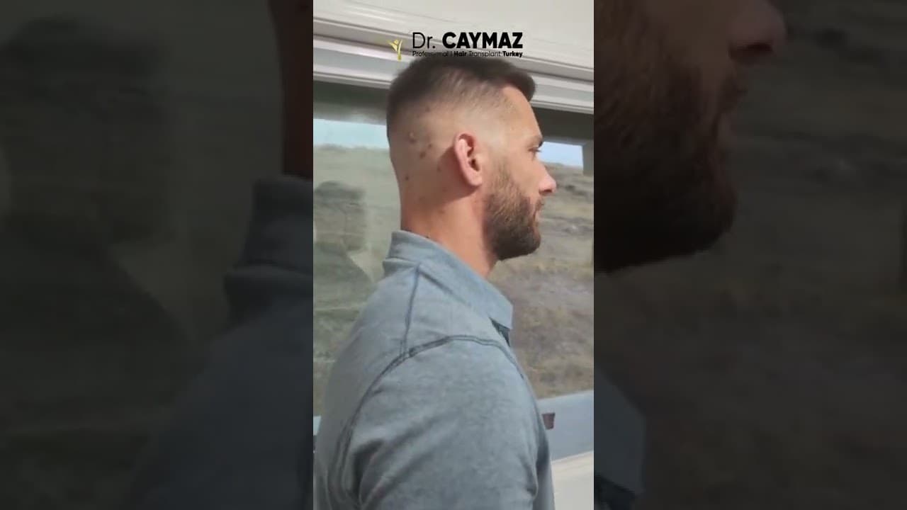 Mr Markus 7 Months DHI 3000 Graft