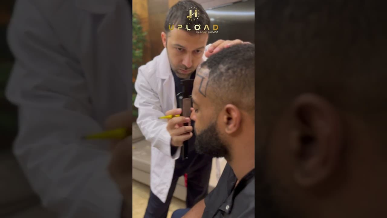 Afro Hairline Creating by Dr Caymaz