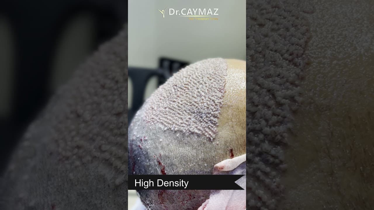 High Density Hair Implantation