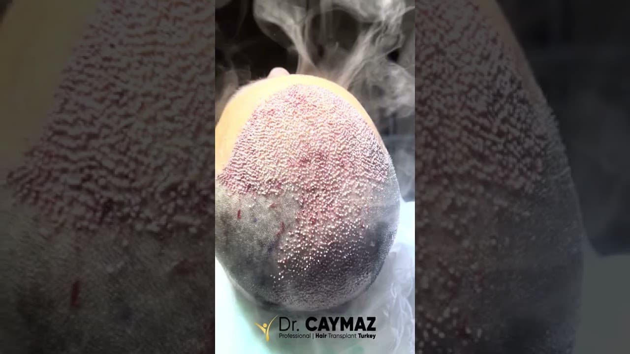 Dense Hair Transplantation