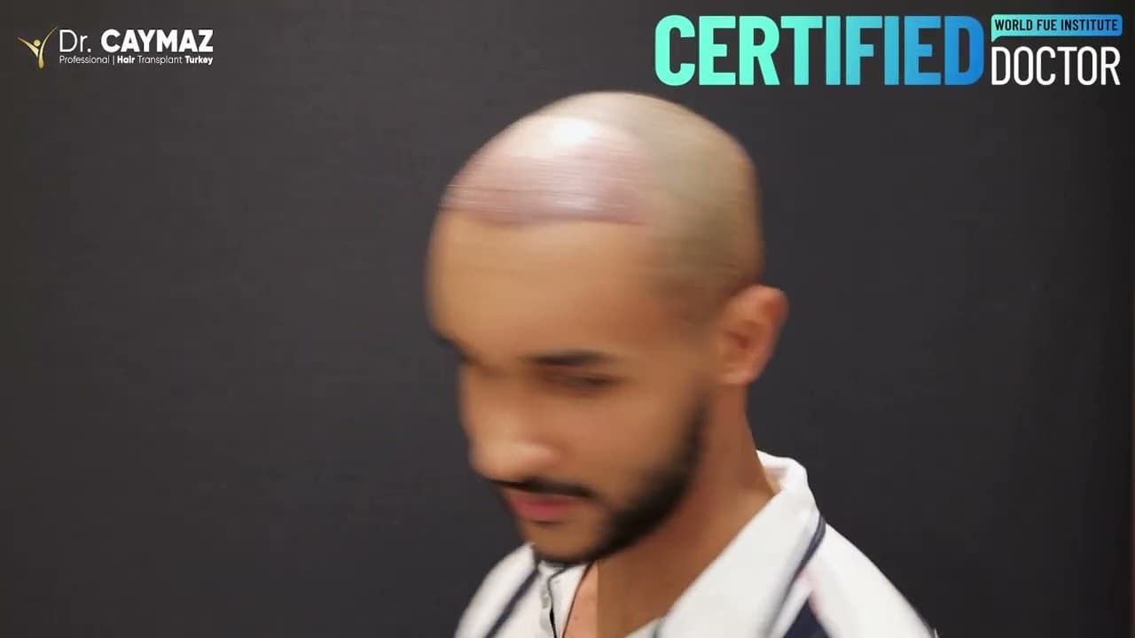 Taha Mohamed | Sapphire FUE | 2700 Graft | USA - Hair Transplant