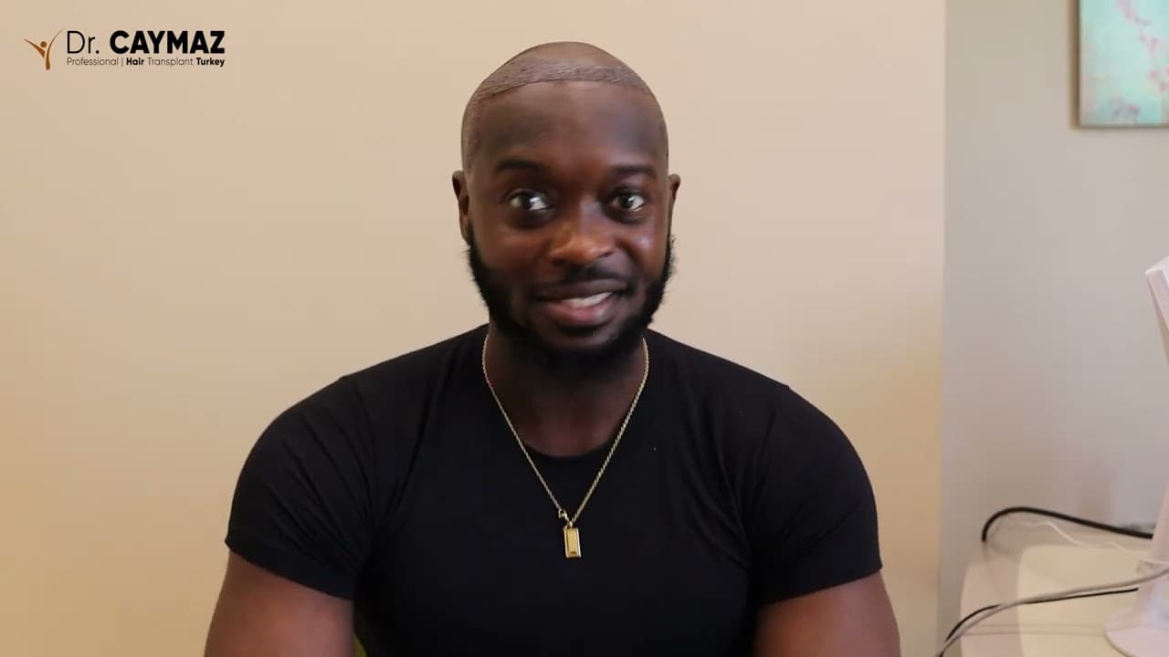 Samuel Abaku Adusei - USA - 2100 Graft - Afro American Hair Transplant Review - Sapphire FUE