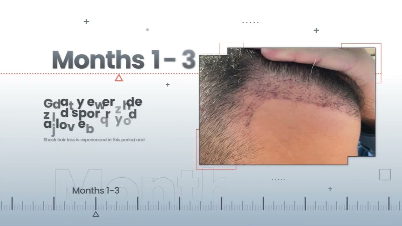 Hair Implantation Timeline