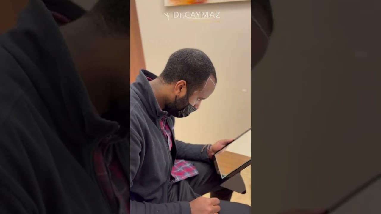 Dr Caymaz afro hairline planning