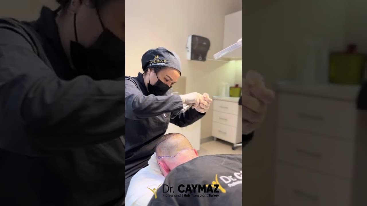 Vip Hair Transplant in Istanbul