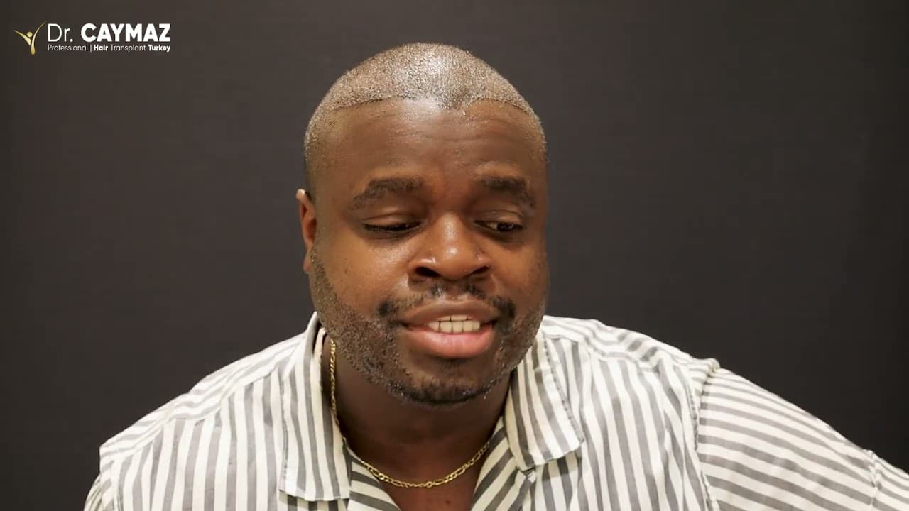 Hair Transplant | Sapphire FUE | 3200 Graft | USA