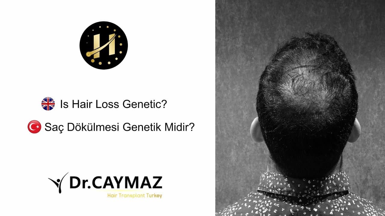 Is Hair Loss Genetic