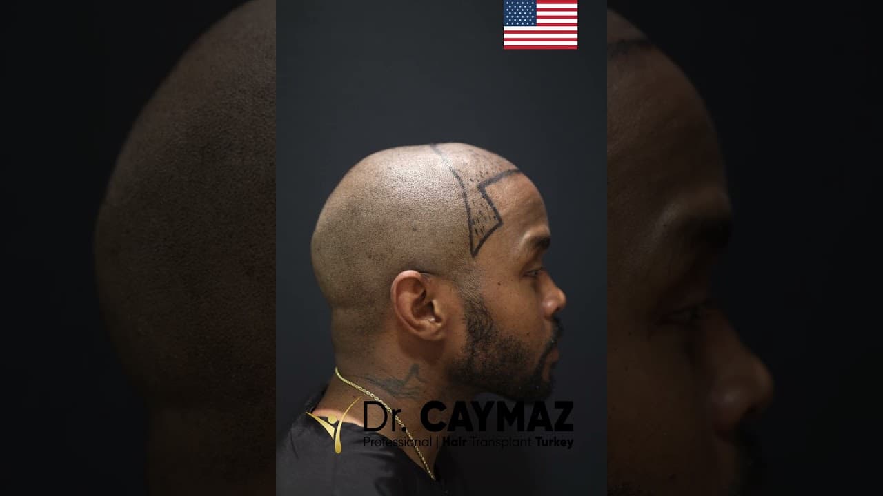 3200 Graft 6 Months Afro Result