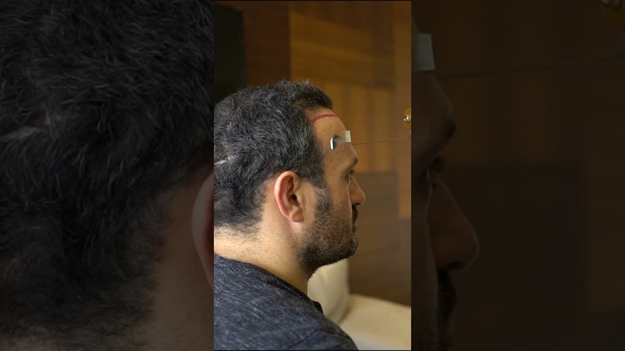 Hair Implantation in Istanbul