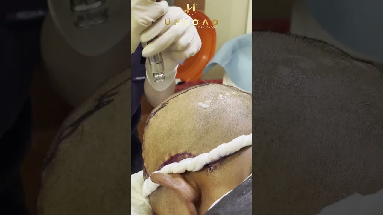 PAINLESS ANESTHESIA DEVICE