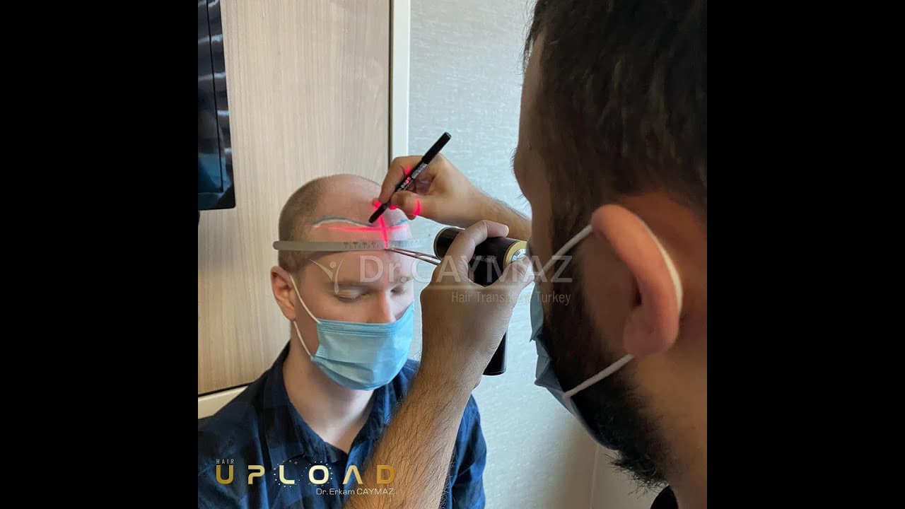 Mr Brandon 5 Months - 5500 Graft - Sapphire Fue | Dr Erkam CAYMAZ - Hair Transplant Turkey