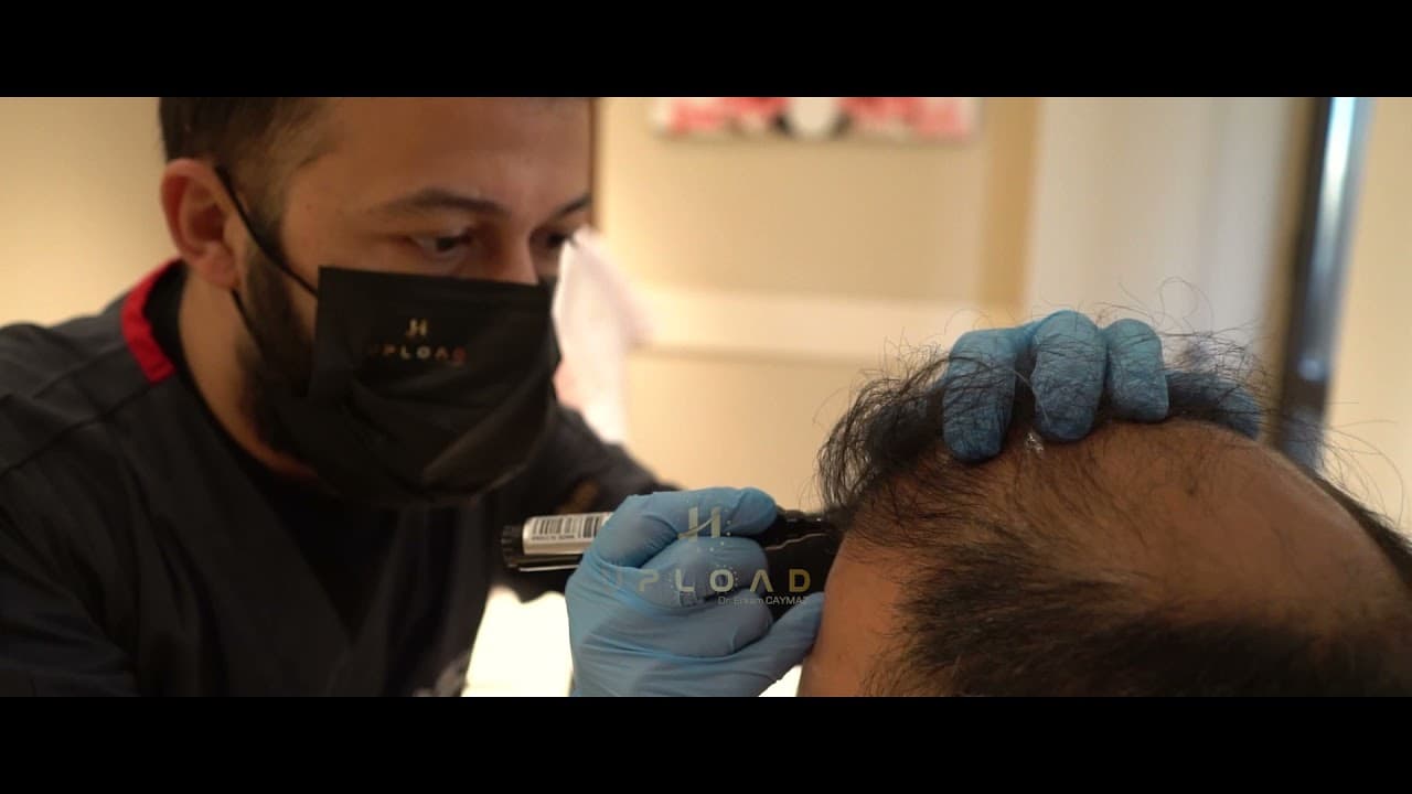 Hairline Designing by Dr CAYMAZ