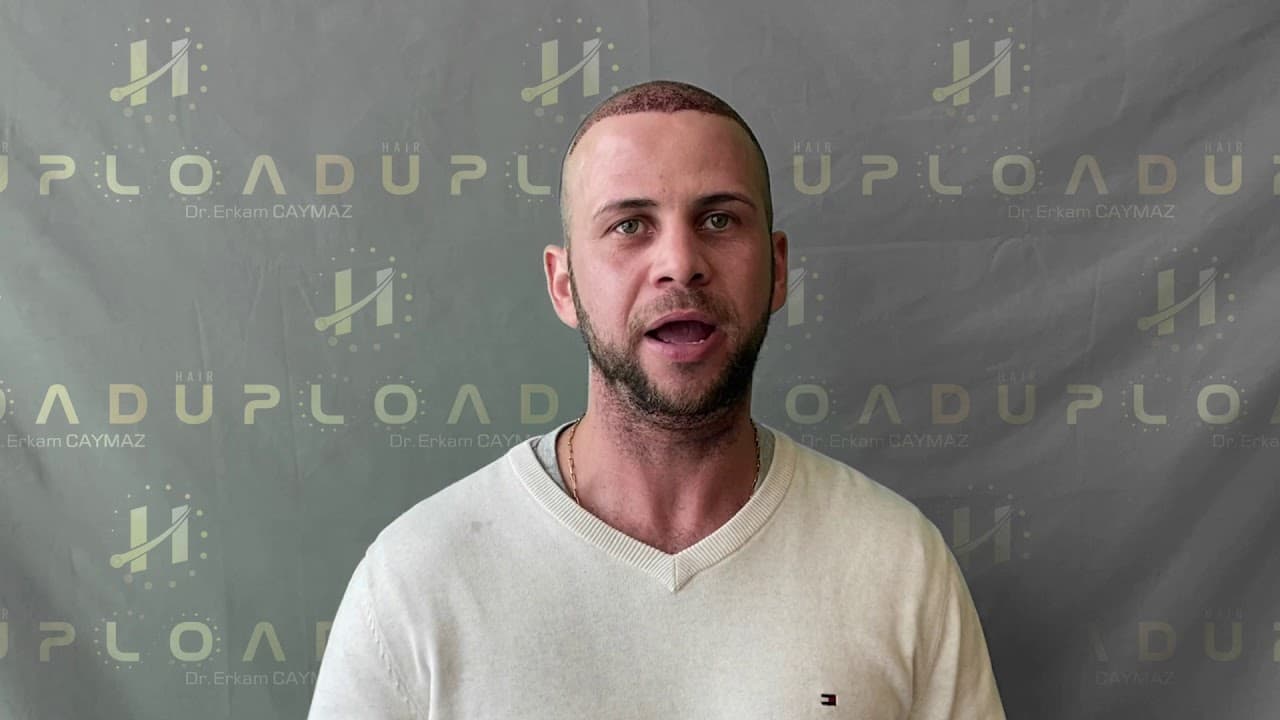 Mr Daniel from USA - Hair Upload - Best Hair Transplant Doctor