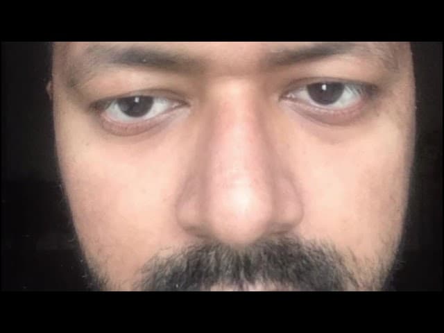 Mr Jino Hair Transplant Review 4500 graft 8 Month Result