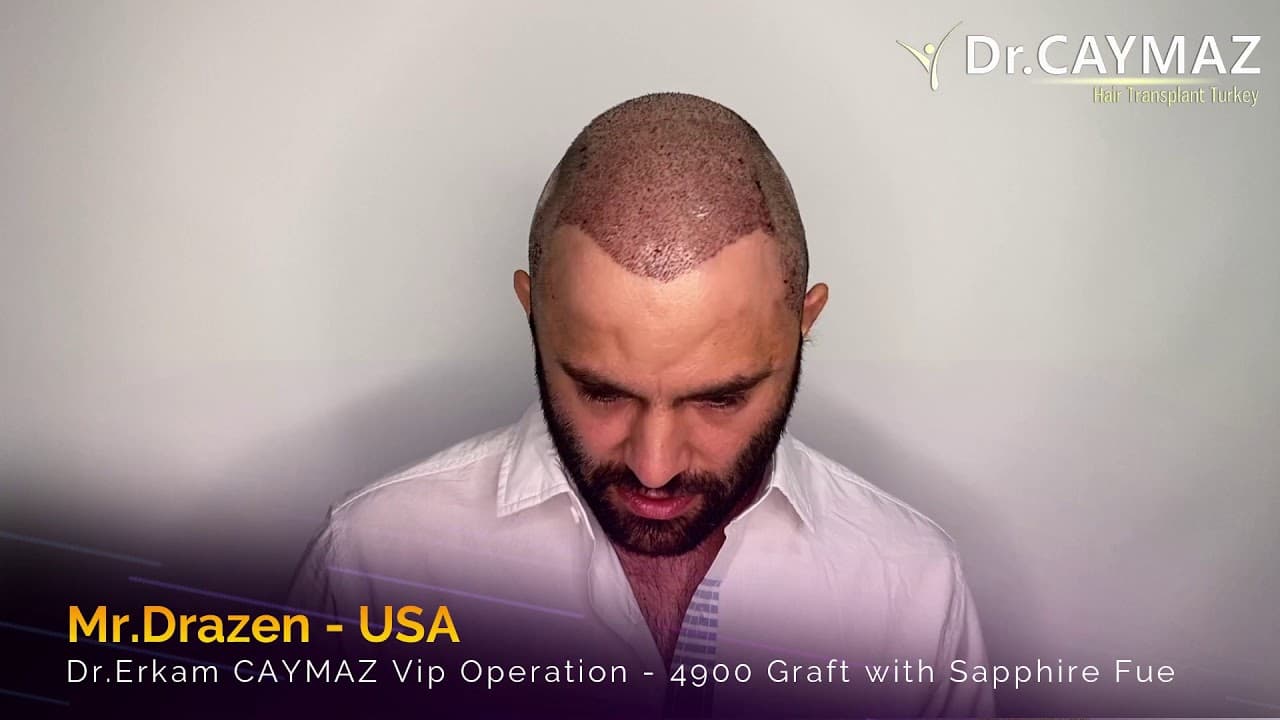 Mr Drazen - USA - 4900 Graft | Hair Transplant in Turkey Istanbul | Sapphire Fue