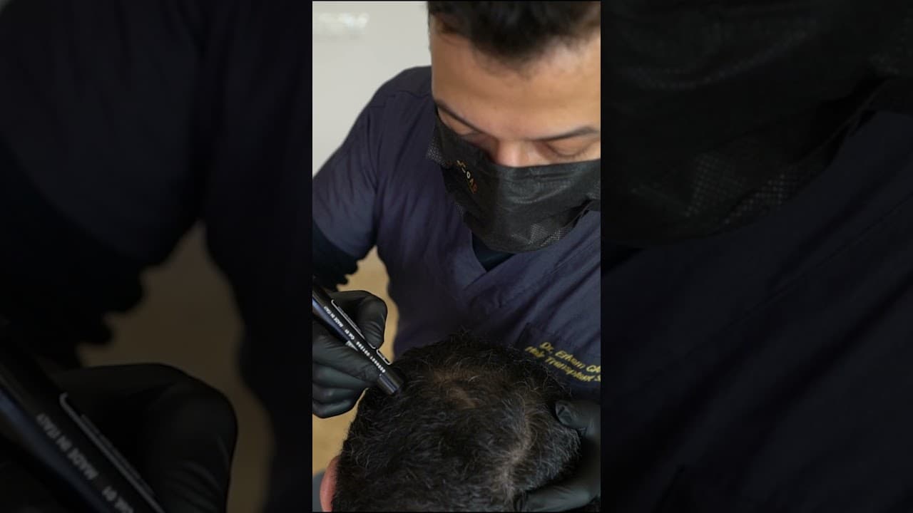 Hair Transplantation in Istanbul