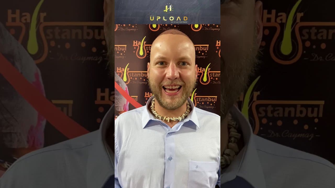 Mr Zillgitt from USA Denver - 4700 Graft | Hair Transplant