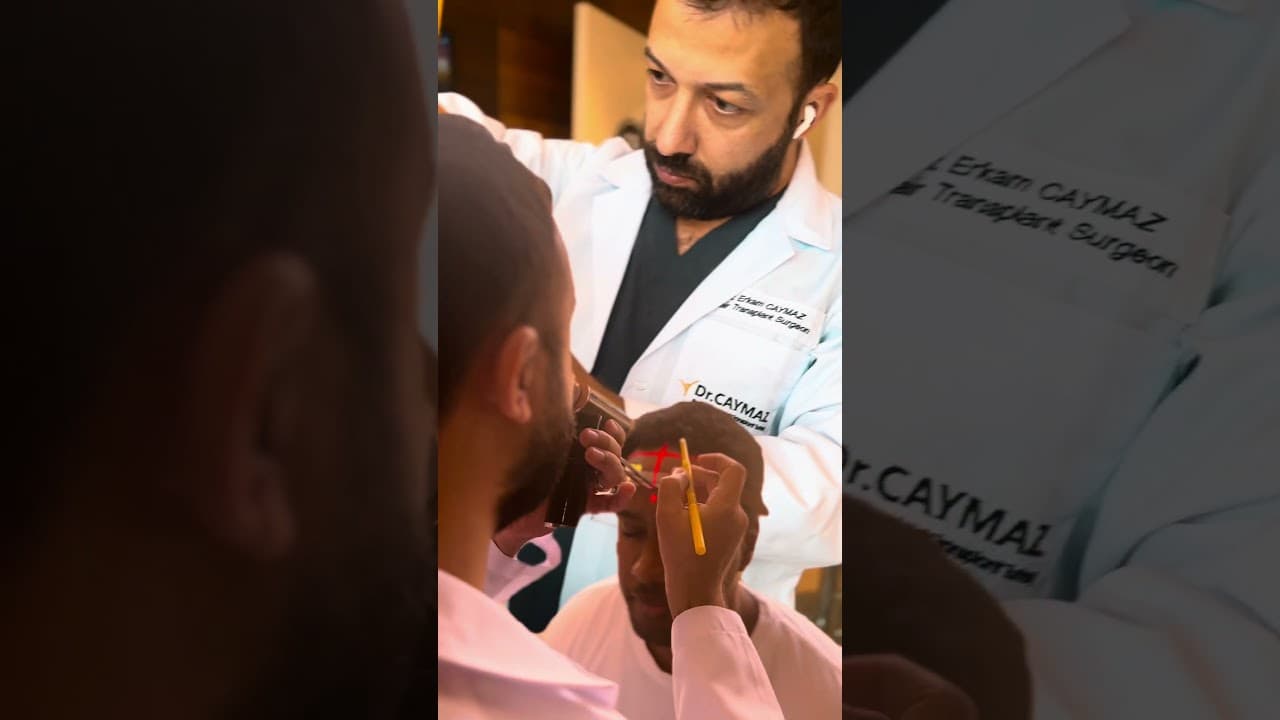 1-2 Vip Hair Transplantation per Day! #hairdoctor #hairtransplant #hairtransplantdoctor #hair