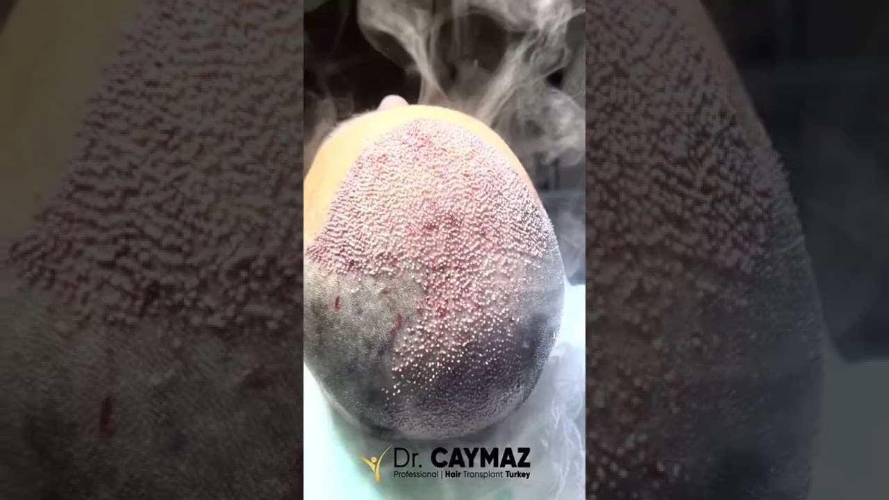 Dense Hair Transplantation in Istanbul