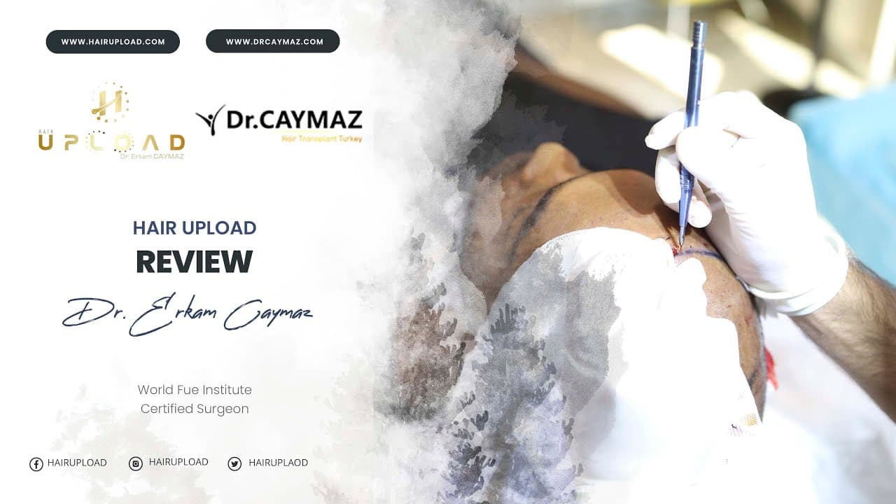 Leonardo Puello | Sapphire FUE | 4000 Graft | USA - Hair Transplant