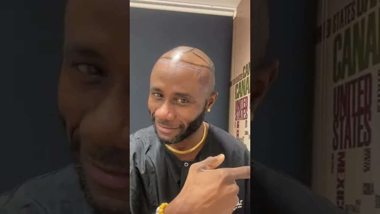 Mr Christopher - Hair Transplant review in Turkey