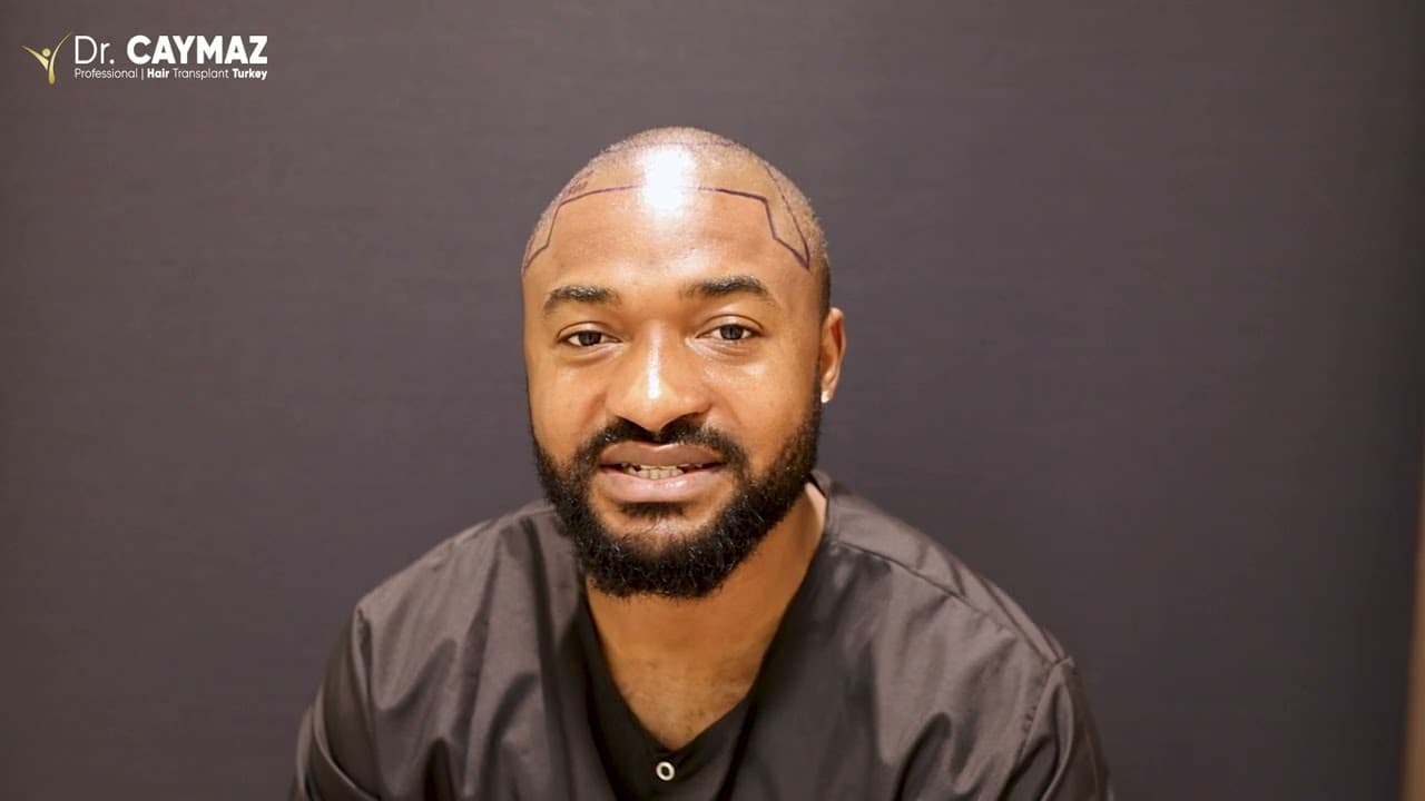 Jean Baptiste TSANGA- ENGLAND- 2500 Graft - Afro American Hair Transplant Review - Sapphire FUE