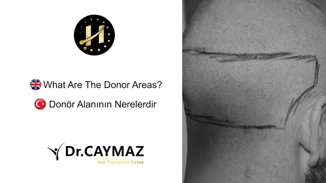 What are the Donor Areas? - Hair Transplant in Turkey