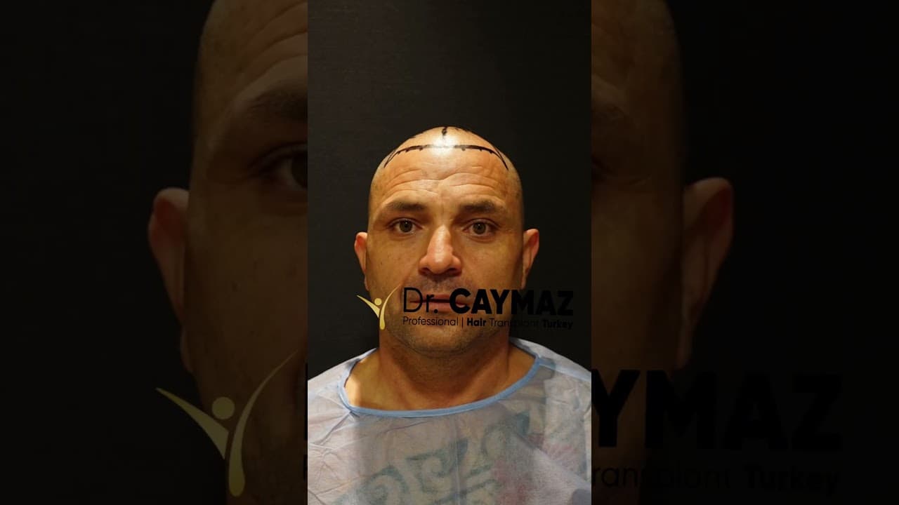 Mr.Elvir | 5250 Graft | 18 Months Result