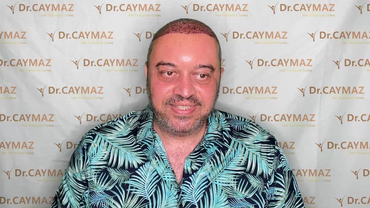 Mr Florin - 5100 graft from UK | Hair Transplant Review