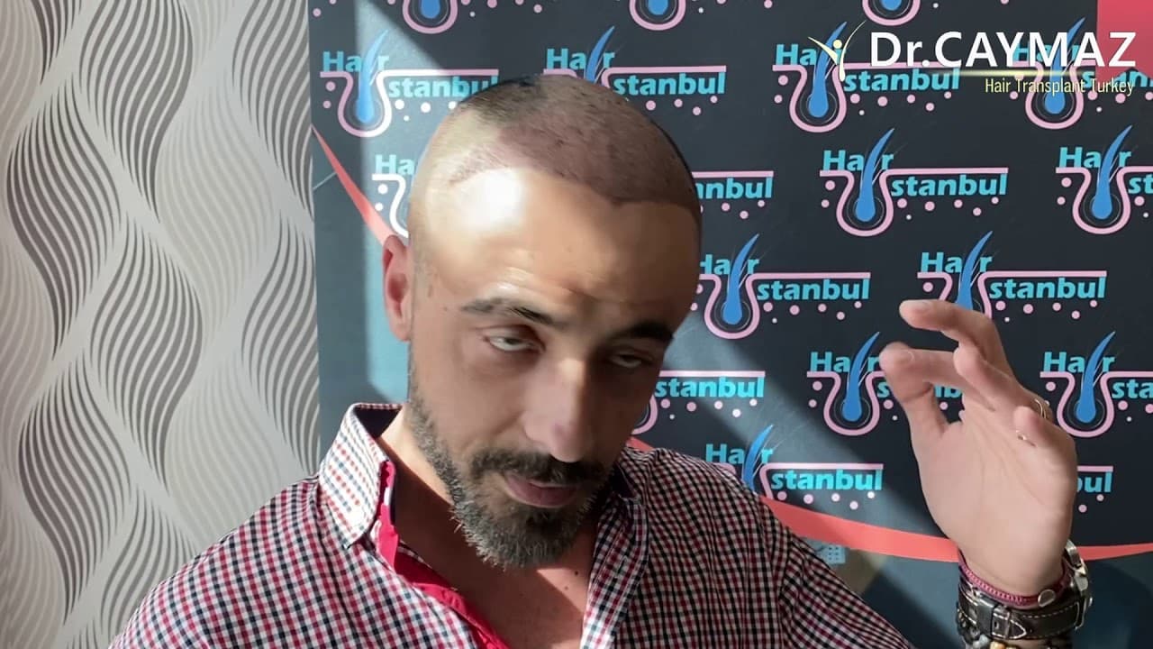 Mr Alexandros from Italy - 5200 Graft Implanted | Hair Transplant in Turkey Istanbul | Fue