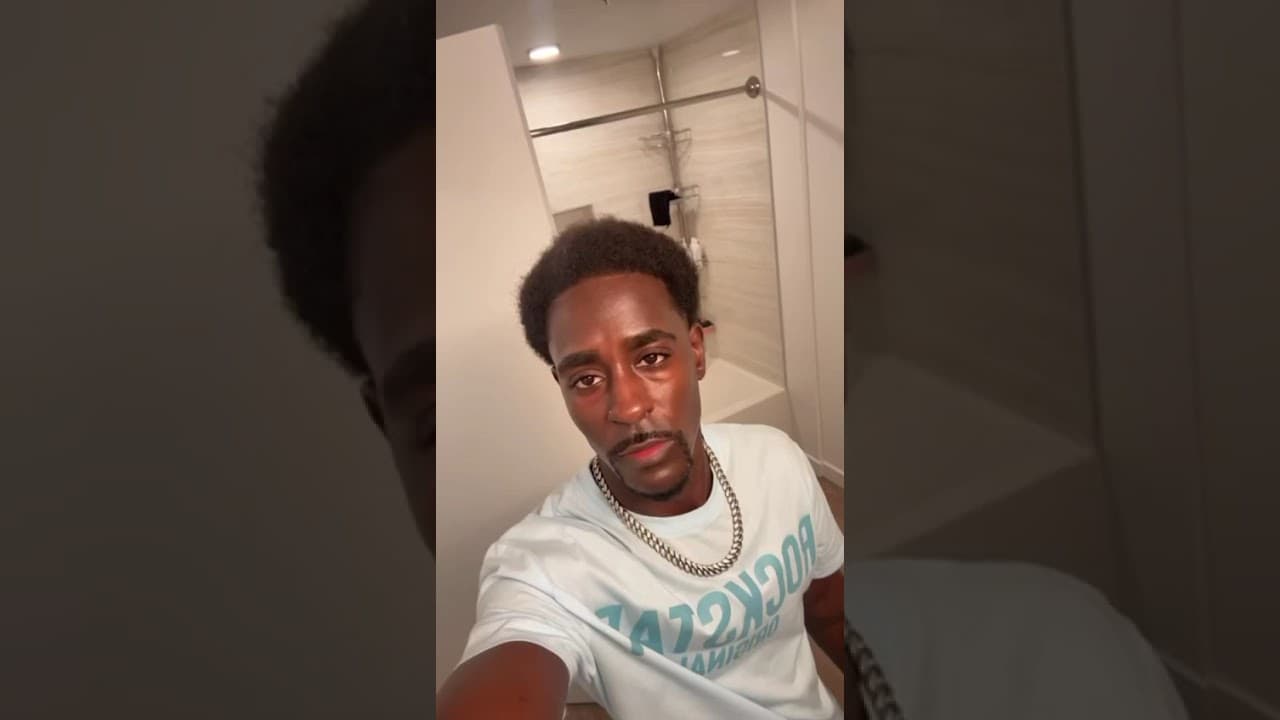 Incredible Hair Transplant Result