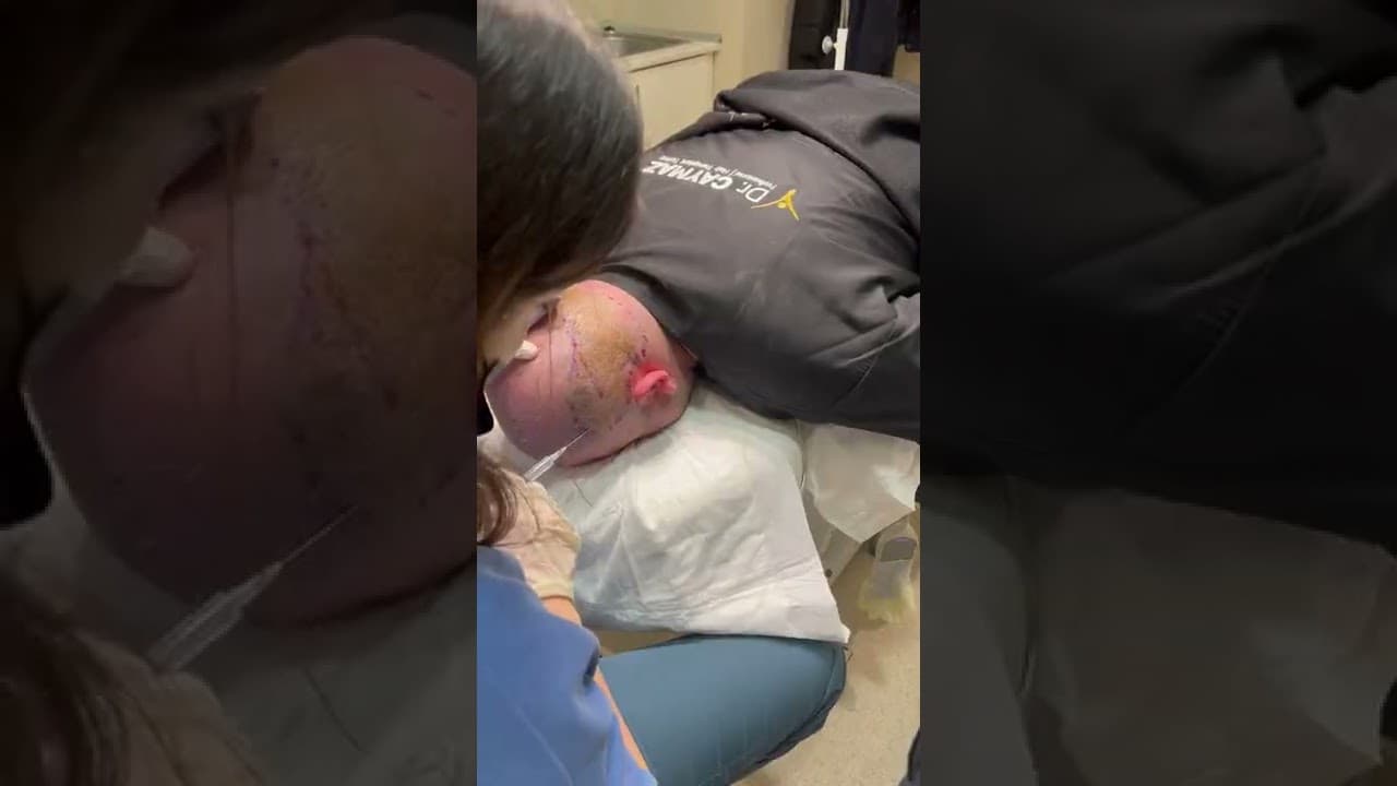 Private and Vip Hair Transplant Operations in Turkey