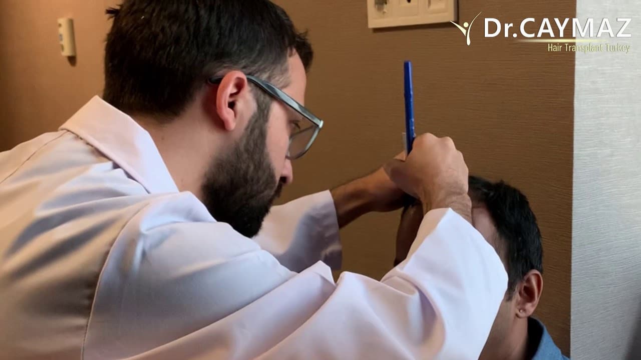 Consultation and Hair Line Design in Turkey - Istanbul