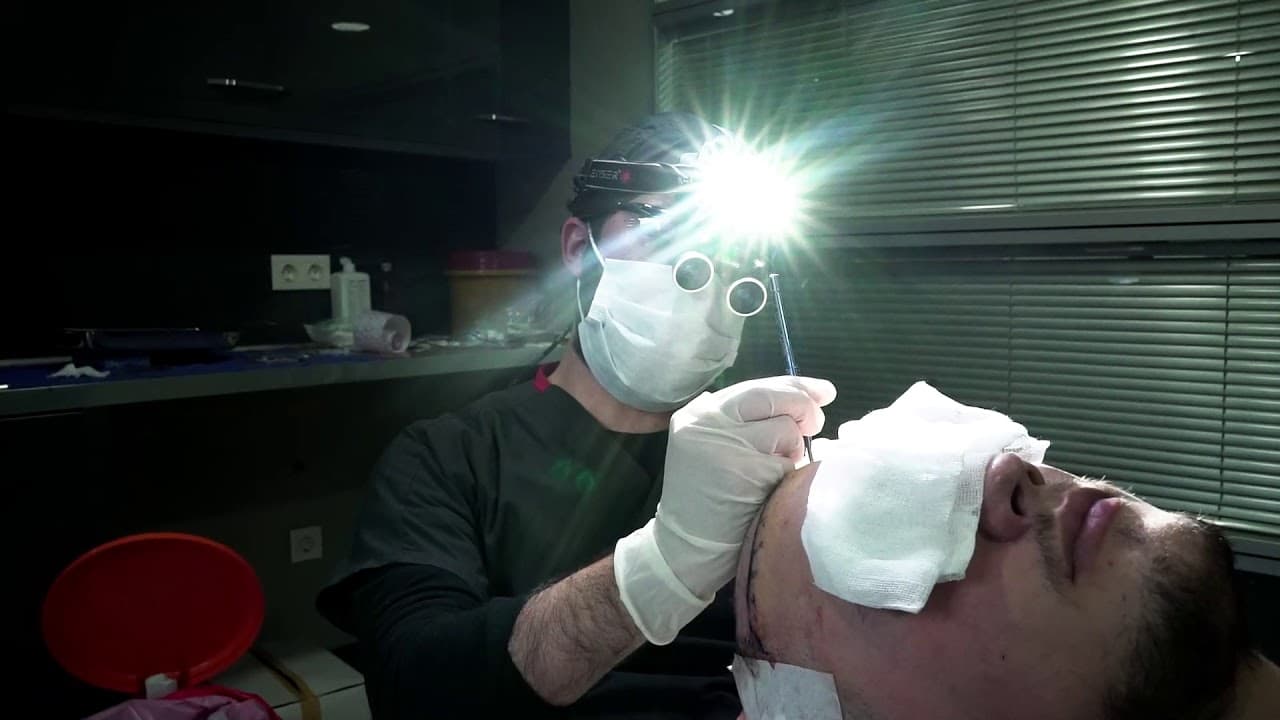 Hair Transplant Turkey Istanbul Dr Erkam Caymaz - Sapphire Fue Hair Transplantation