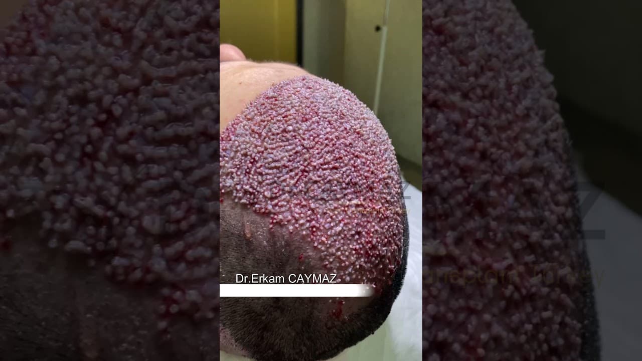 High Density Hair Transplantation