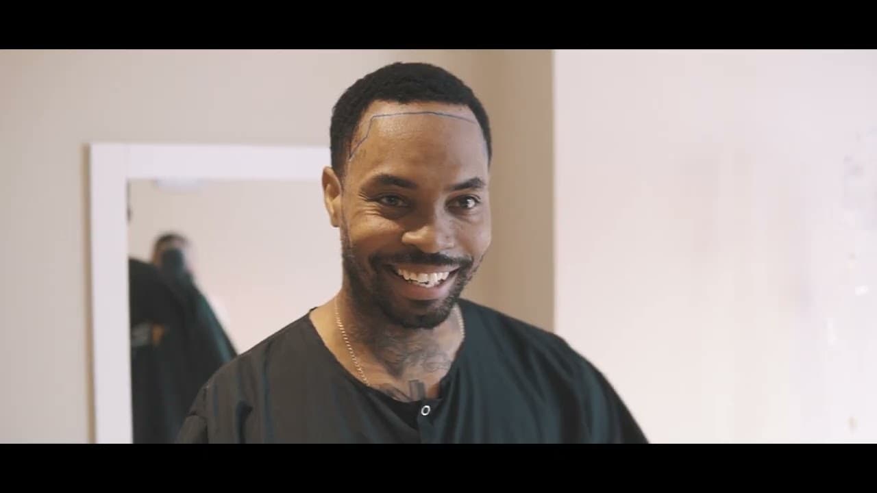 Best Hair Transplant Clinic in Turkey