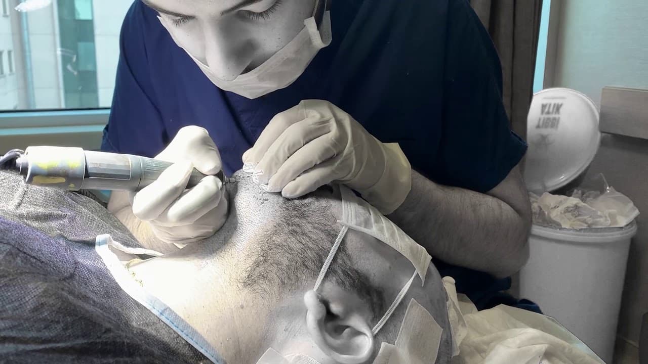 Beard Donor Areas - Body Hair Transplant