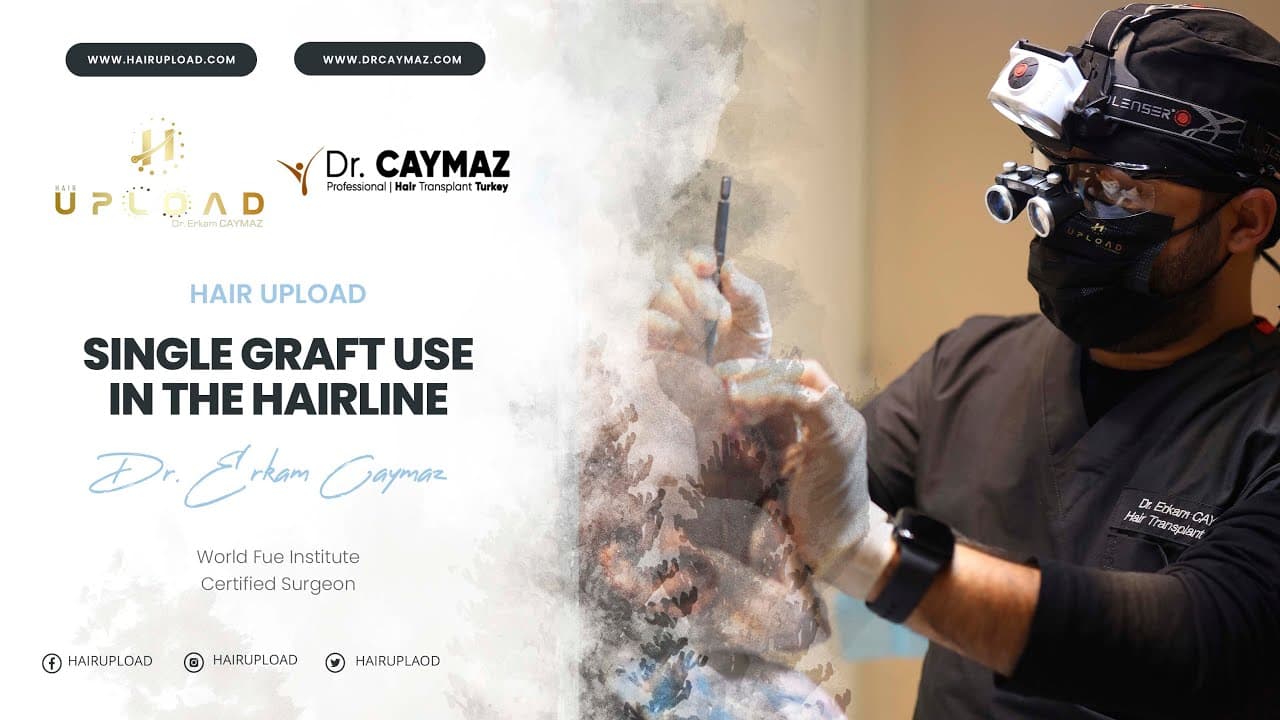 Single graft use in the hairline