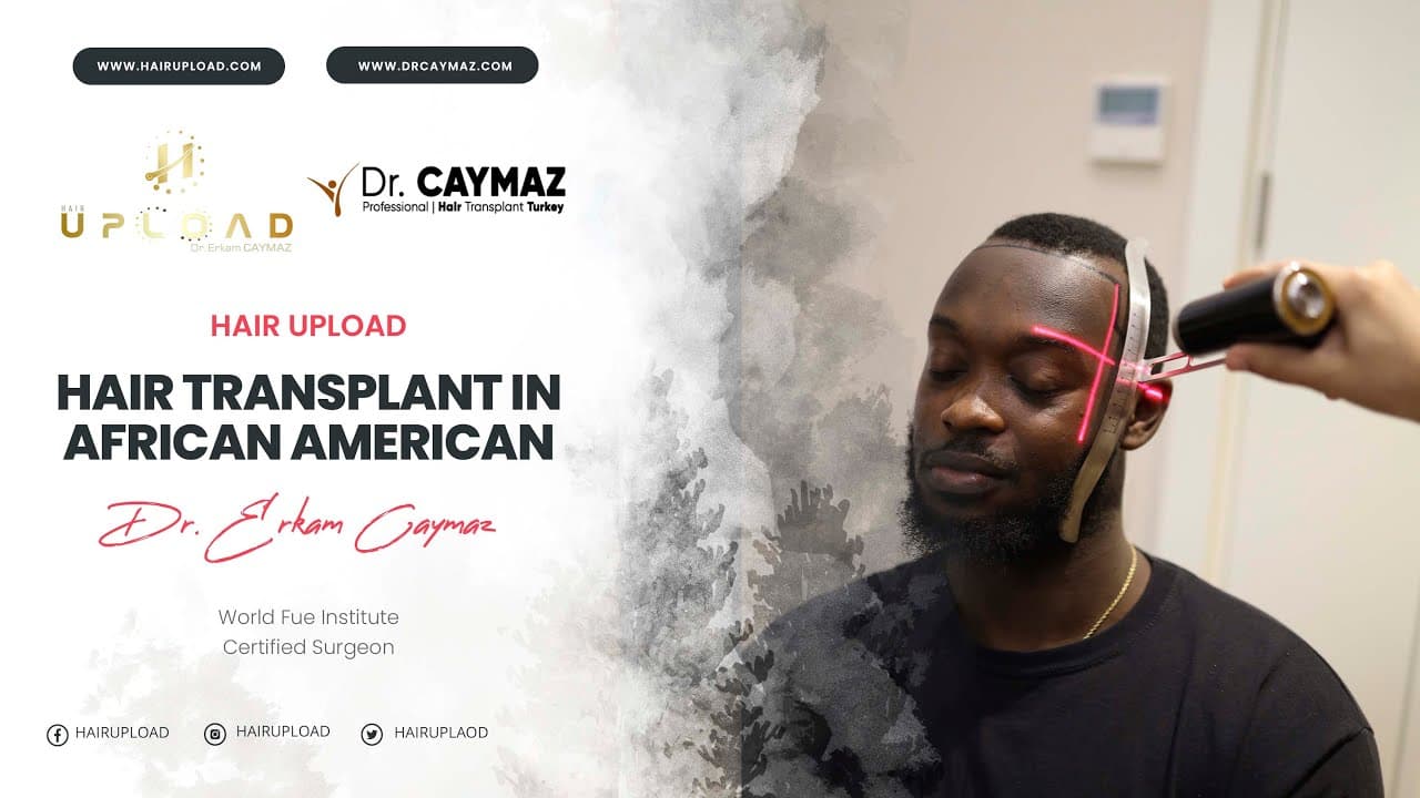 Hair Transplant in African American - Hair Transplant Turkey