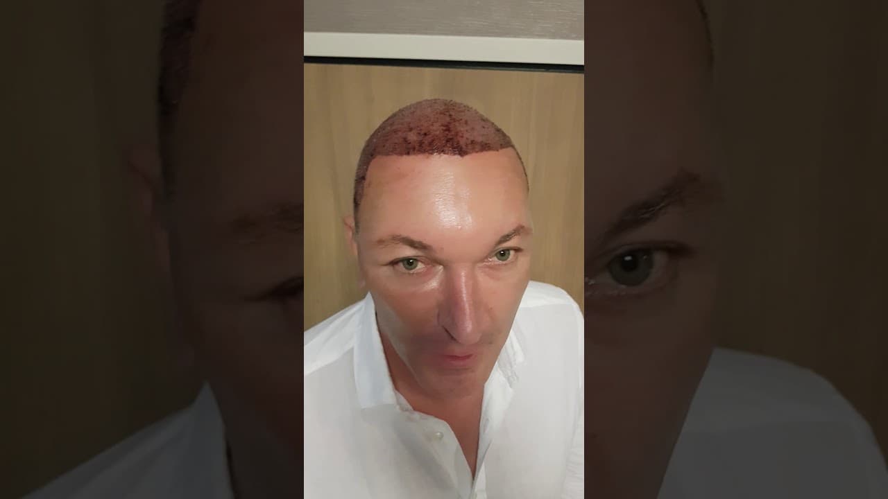 Private Hair Transplant - Hair Upload Dr Erkam Caymaz